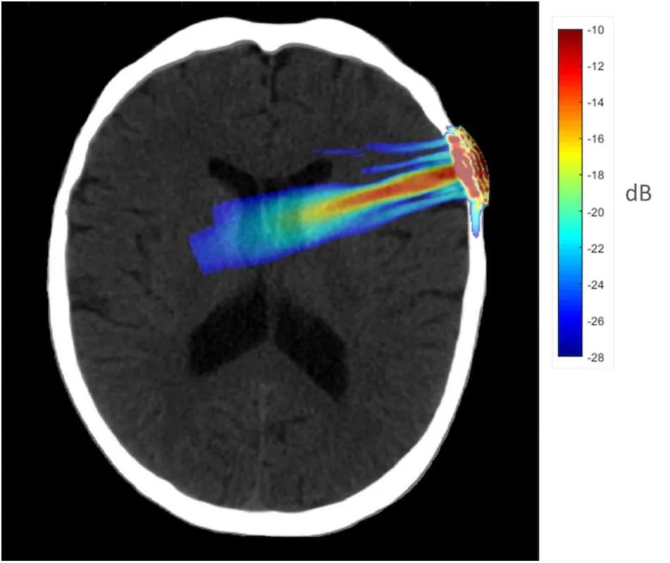 Acoustic simulation model on a representative CT scan